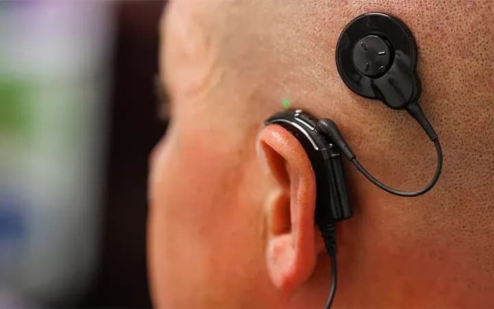 Pentingnya Mapping Rutin untuk Pengguna Cochlear Implant